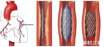 碳纖維材料在醫(yī)療領(lǐng)域的創(chuàng)新應用，碳纖維材料在醫(yī)療領(lǐng)域的創(chuàng)新應用與前景展望 行業(yè)新聞 第4張